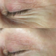 Hydropeptide Collagel+: Line Lifting Hydrogel Mask for Eye voor en na resultaat