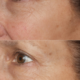 Hydropeptide-synerc-pigmentvlekken-voor-en-na