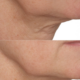 Hydropeptide-Syner-C- Serum-voor-en-na