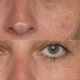 hydropeptide-syner-c-serum-pigmentvlekken-resultaat